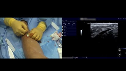 Left Great Saphenous Vein Ablation with the Venclose™ RF Ablation Catheter, Featuring Dr. Jeffrey Carr (Case 2)
