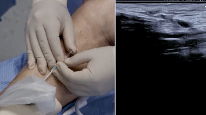 Medial Ankle Perforator Treatment with the Venclose Maven™ Perforator Catheter, Featuring Dr. Jeffrey Carr (Case 2)