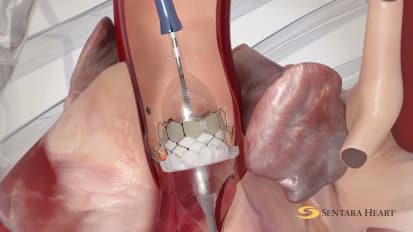 Advances in the Transcatheter Aortic Valve Replacement