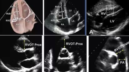 Multimodality Imaging in Pulmonary Vascular Disease