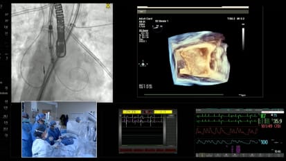 Treating Aortic Regurgitation