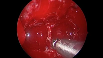 Nasal Endoscopy to Access a Pituitary Tumor 