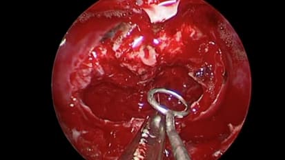 Surgical Resection of a Large Pituitary Adenoma