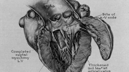 Hypertrophic Obstructive Cardiomyopathy (HOCM)