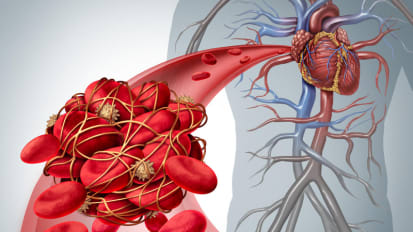 Bioprosthetic valve thrombosis: A perhaps not-so-rare complication