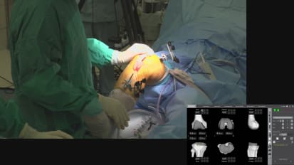 The Tri-Plane Approach to Robotic TKA, A Systematic, Reproducible Technique.