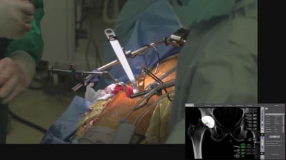 The Learning Curve adopting robotic THA for Direct Anterior (DAA) surgeons.