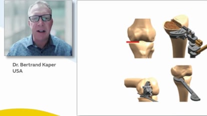 Dr. Bertrand Kaper: Overcoming UKA Challenges with New Implant Design and Handheld Robotics