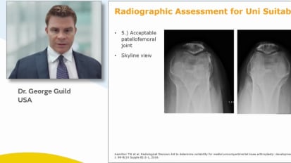 Dr. George Guild: Overcoming UKA Challenges with New Implant Design and Handheld Robotics