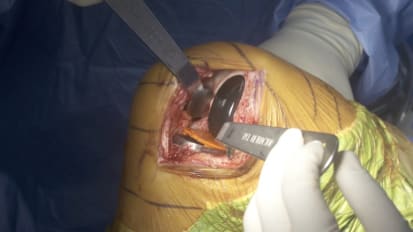 Lateral JOURNEY II UK Surgical Technique Video