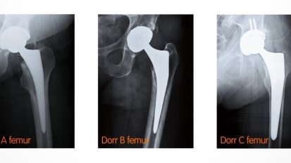 Animation: POLARSTEM™ Cementless Stem System