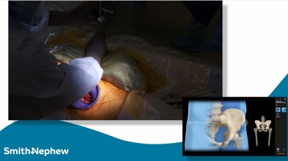 Live Surgery: Advanced Solutions for Personalized Cup Placement 