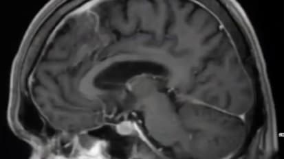 Neurosurgical Conditions on Adult MRI of the Brain