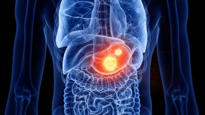 Sensitivity to Chemotherapy May Guide Treatment of Patients with Stomach Cancer