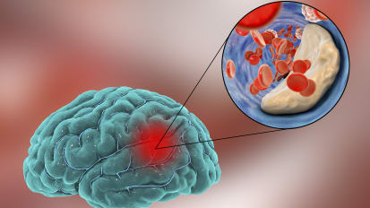 Gender-Specific Differences in Stroke Clinical Presentation and Risk Factors