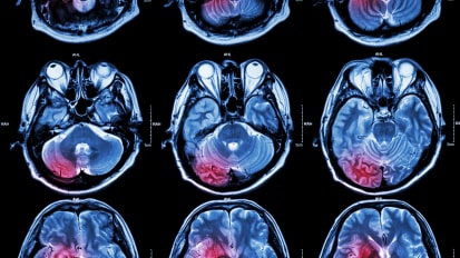 Gender-Specific Differences in Stroke Management and Outcome