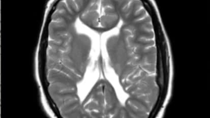 Surgical Options Available for Spasticity Management in the Pediatric Patient