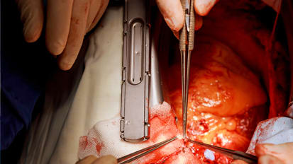 Treatment Options for Mitral Valve Disease: Contemporary Update and Future Options