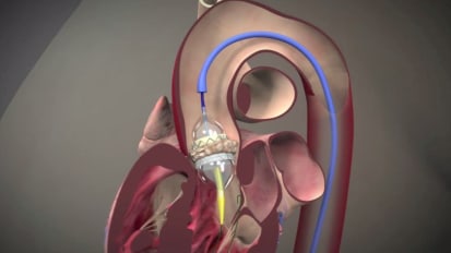 TAVR: An option for inoperable aortic stenosis