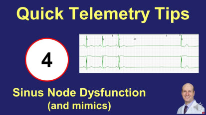 Telemetry Tips Part 4: Sinus Node Dysfunction