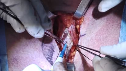 Total thyroidectomy with central neck dissection