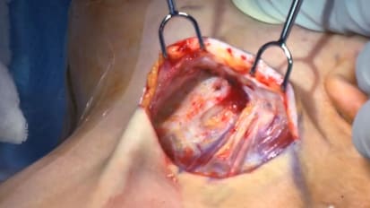 Transcervical exploration of parapharynx for deep lobe parotid pleomorphic adenoma