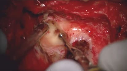 Translabyrinthine approach for vestibular schwannoma