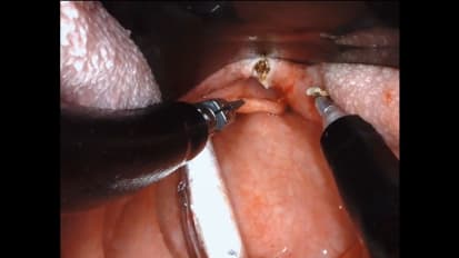 Transoral robotic surgery (TORS) resection of tongue base tumor