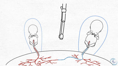 Twin to Twin Transfusion Syndrome: Part 2 of 2