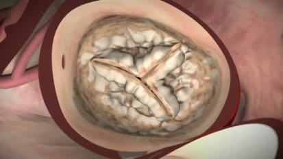 Transcatheter Aortic Valve Replacement (TAVR) - A Less-Invasive Alternative to Open Heart Surgery