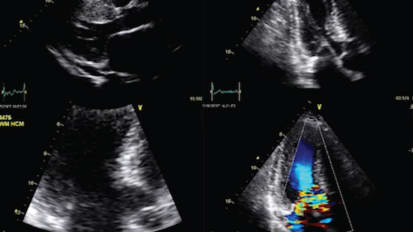 Imaging in HCM Management: Diagnosis, Monitoring & Treatment