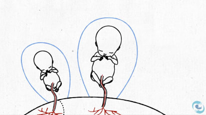 Unequal Placental Sharing