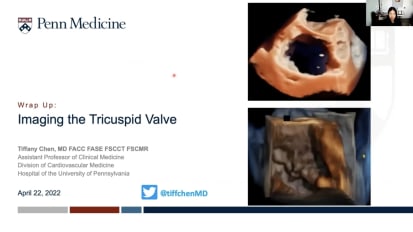 Imaging the Tricuspid Valve