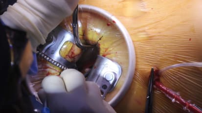 Minimally Invasive Mitral Valve Repair 