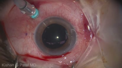 Placement of a Sutureless Secondary Intraocular Lens 