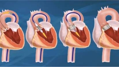 Aortic Stenosis: Diagnosis, Prognosis and Treatment Update