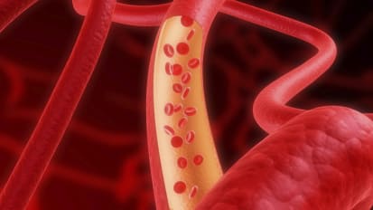 Thromboelastography & Coagulation Management in Trauma