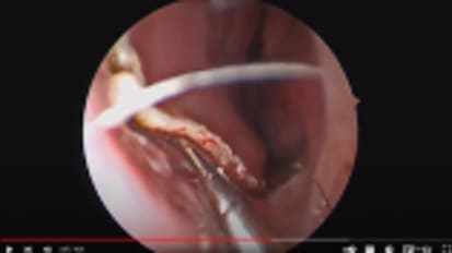 Nasoseptal flap for skull base reconstruction