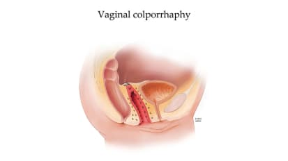 Treatment options for pelvic organ prolapse