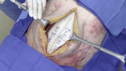 Retromuscular hernia repair using GORE<sup>®</sup> ENFORM Preperitoneal Biomaterial with percutaneous suture fixation