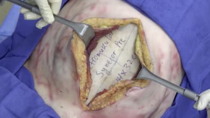 Retromuscular Hernia Repair Using GORE<sup>®</sup> SYNECOR Preperitoneal Biomaterial with Transfascial Suture Fixation [Full Version]