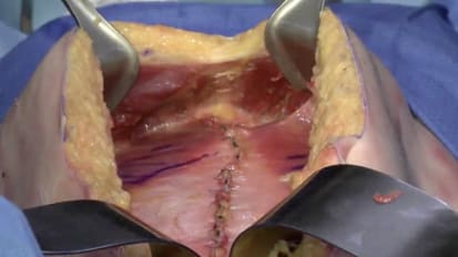 Retromuscular Hernia Repair Using GORE<sup>®</sup> SYNECOR Preperitoneal Biomaterial with Transfascial Suture Fixation