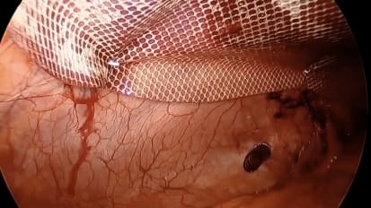 Laparoscopic Ventral Hernia Repair using GORE® SYNECOR® BioMaterial