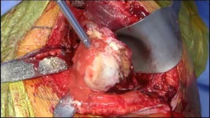 十大技巧Glenoid曝光