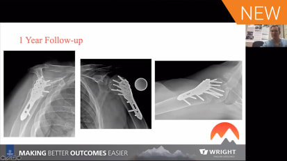 Nail, Plate, or Arthroplasty? Clinical Decisions for Proximal Humerus Fractures