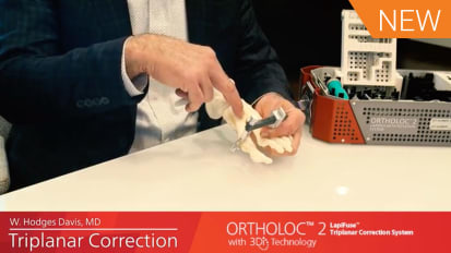 ORTHOLOC™ 2 LapiFuse™ Triplanar Correction Clamp [AP-013482A]