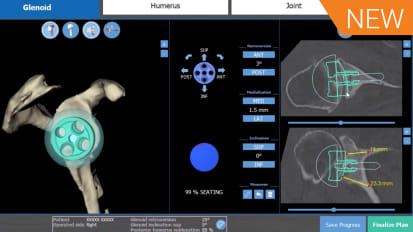 BLUEPRINT™ Plan Optimization for a B2 Deformity featuring Dr. Shannon Carpenter [AP-011148A]