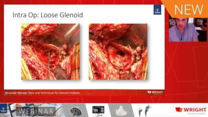 Shoulder Revision Tools and Techniques: Glenoid Implants [AP-012441]