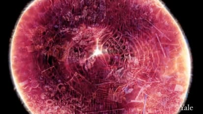 Gaucher Disease