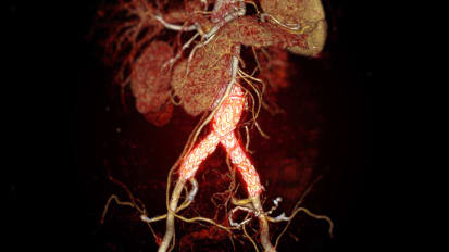 The Future of Aortic Surgery: Cutting-Edge Techniques and Research